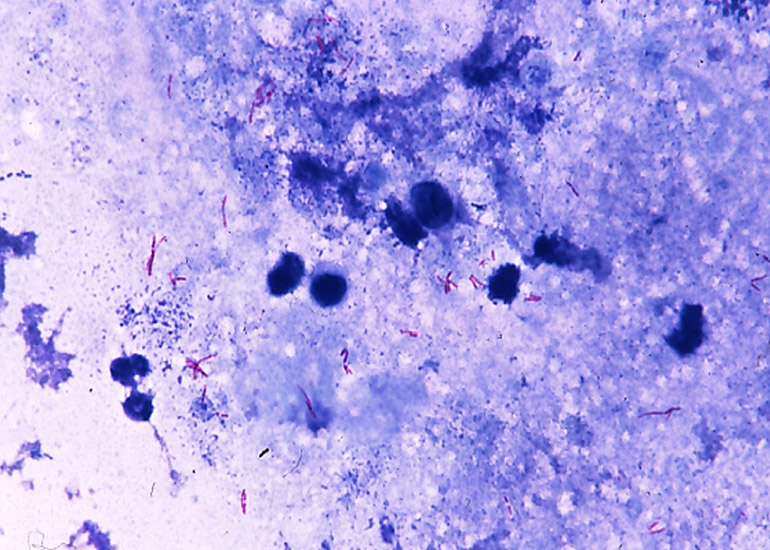 結核菌 Mycobacterium tuberculosis